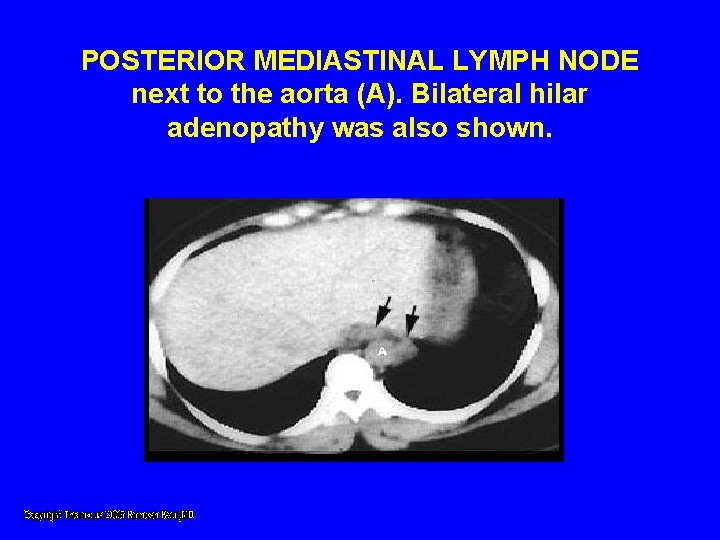 POSTERIOR MEDIASTINAL LYMPH NODE next to the aorta (A). Bilateral hilar adenopathy was also POSTERIOR MEDIASTINAL LYMPH NODE next to the aorta (A). Bilateral hilar adenopathy was also