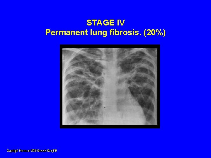 STAGE IV Permanent lung fibrosis. (20%) STAGE IV Permanent lung fibrosis. (20%)