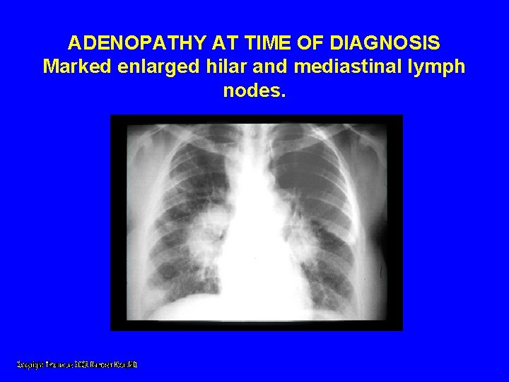 ADENOPATHY AT TIME OF DIAGNOSIS Marked enlarged hilar and mediastinal lymph nodes. ADENOPATHY AT TIME OF DIAGNOSIS Marked enlarged hilar and mediastinal lymph nodes.
