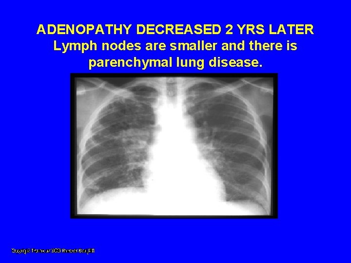ADENOPATHY DECREASED 2 YRS LATER Lymph nodes are smaller and there is parenchymal lung ADENOPATHY DECREASED 2 YRS LATER Lymph nodes are smaller and there is parenchymal lung