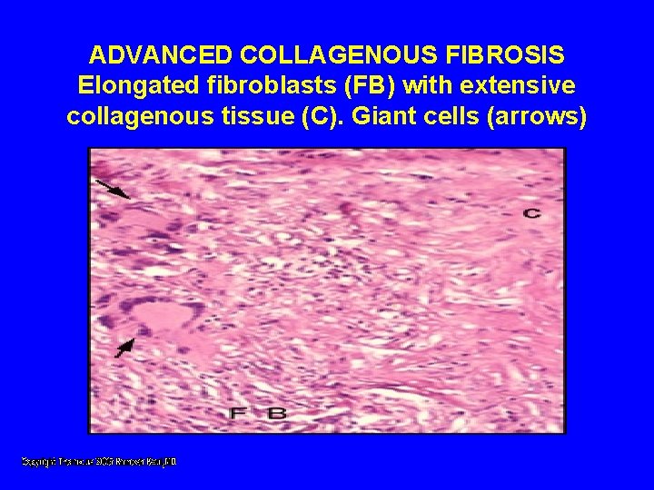 ADVANCED COLLAGENOUS FIBROSIS Elongated fibroblasts (FB) with extensive collagenous tissue (C). Giant cells (arrows) ADVANCED COLLAGENOUS FIBROSIS Elongated fibroblasts (FB) with extensive collagenous tissue (C). Giant cells (arrows)