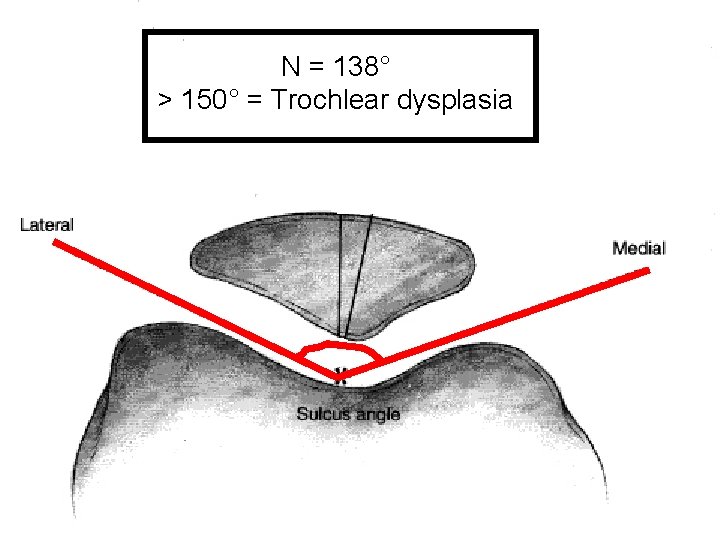 N = 138° > 150° = Trochlear dysplasia 