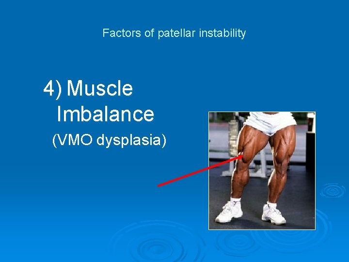 Factors of patellar instability 4) Muscle Imbalance (VMO dysplasia) 