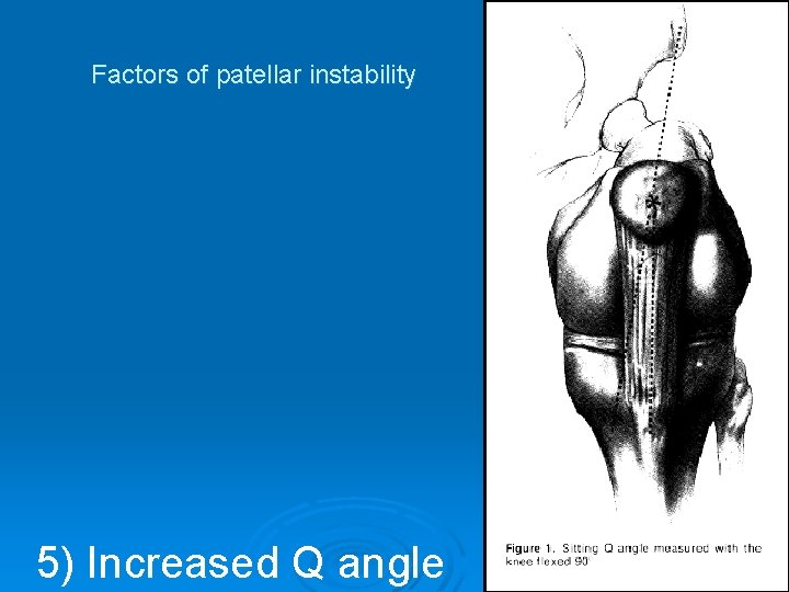 Factors of patellar instability 5) Increased Q angle 