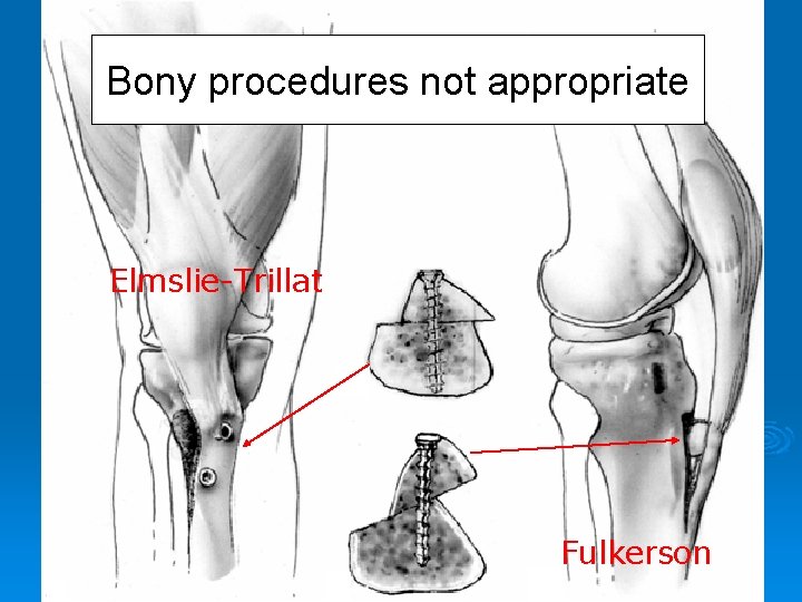 Bony procedures not appropriate Elmslie-Trillat Fulkerson 