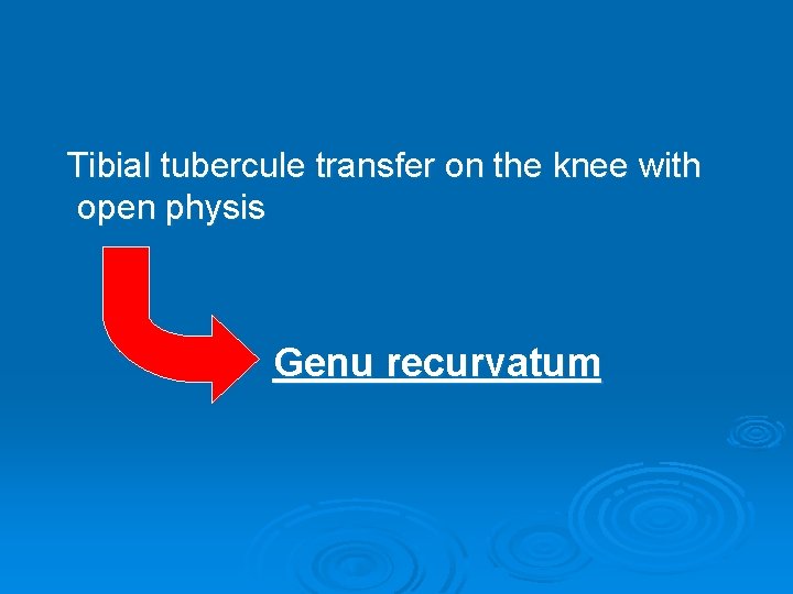 Tibial tubercule transfer on the knee with open physis Genu recurvatum 