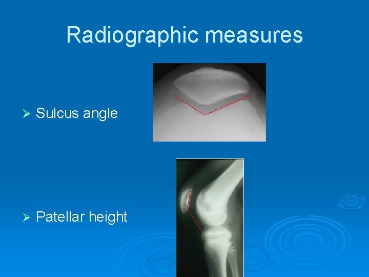 Radiographic measures Ø Sulcus angle Ø Patellar height 