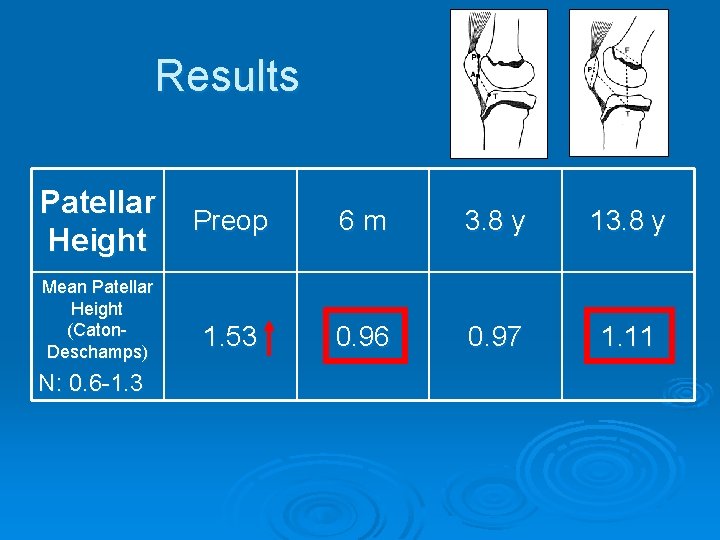Results Patellar Height Mean Patellar Height (Caton. Deschamps) N: 0. 6 -1. 3 Preop