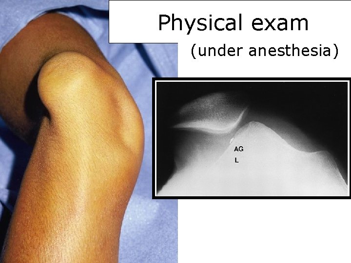 Physical exam (under anesthesia) 