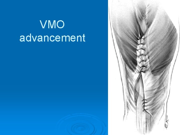 VMO advancement 