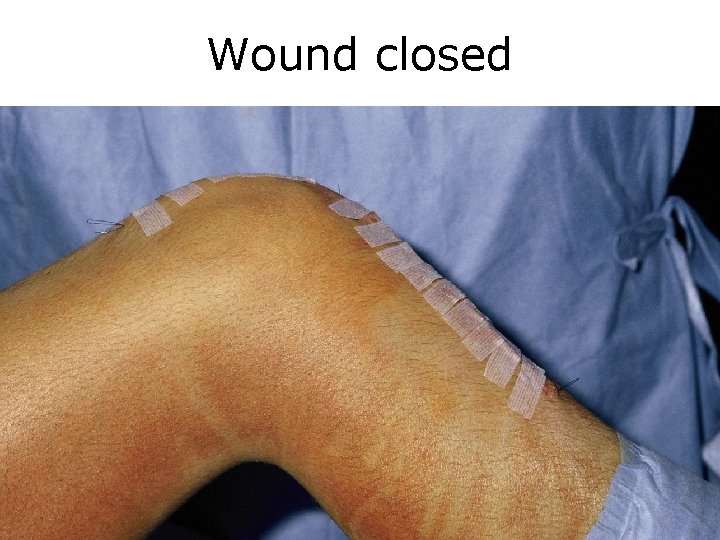 Wound closed 