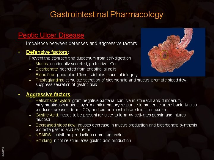 Gastrointestinal Pharmacology Peptic Ulcer Disease Imbalance between defenses and aggressive factors • Defensive factors: