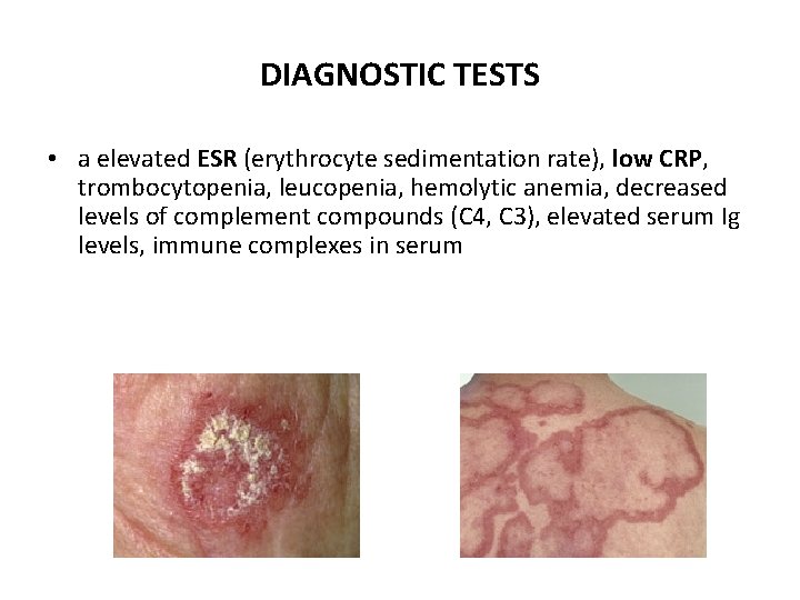 DIAGNOSTIC TESTS • a elevated ESR (erythrocyte sedimentation rate), low CRP, trombocytopenia, leucopenia, hemolytic