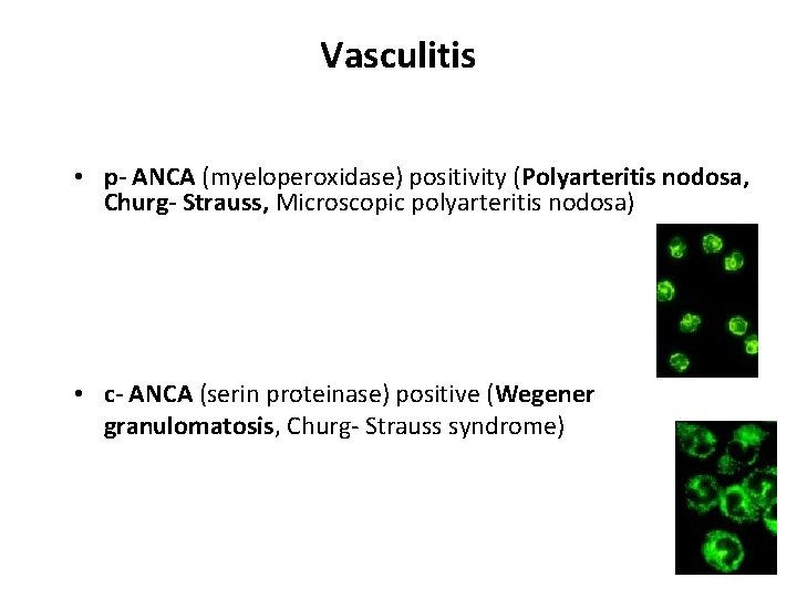 Vasculitis • p- ANCA (myeloperoxidase) positivity (Polyarteritis nodosa, Churg- Strauss, Microscopic polyarteritis nodosa) •