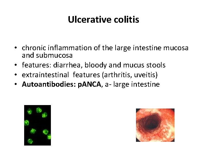 Ulcerative colitis • chronic inflammation of the large intestine mucosa and submucosa • features: