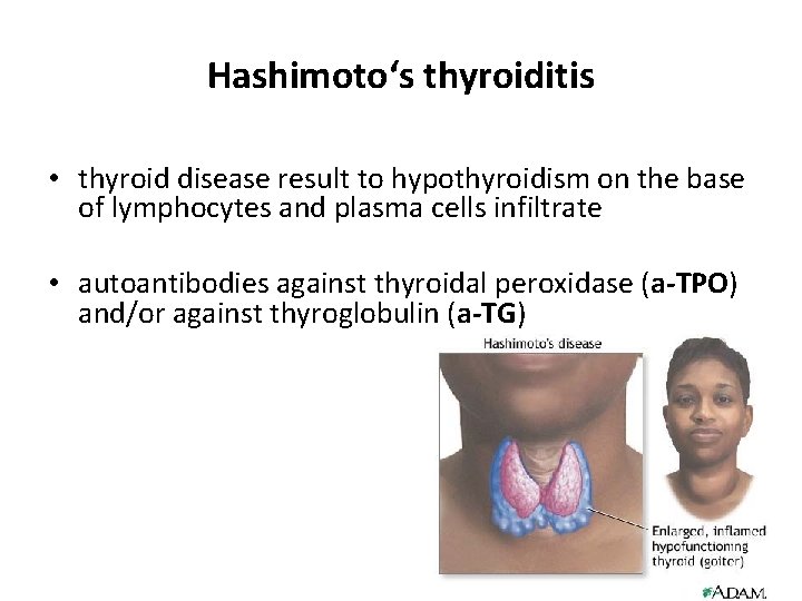 Hashimoto‘s thyroiditis • thyroid disease result to hypothyroidism on the base of lymphocytes and