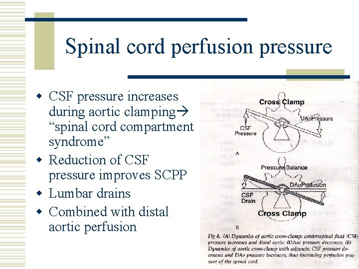 Spinal cord perfusion pressure w CSF pressure increases during aortic clamping “spinal cord compartment