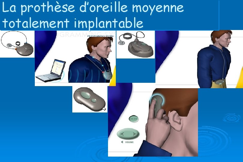 La prothèse d’oreille moyenne totalement implantable 