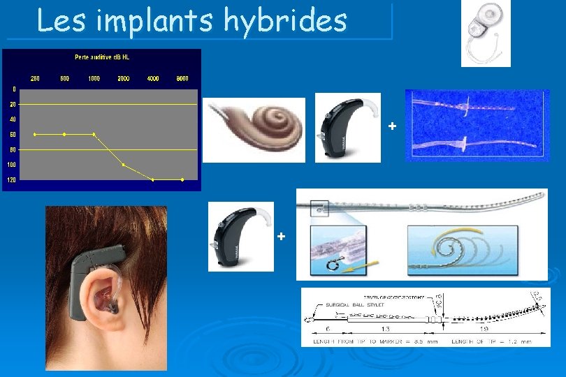 Les implants hybrides + + 