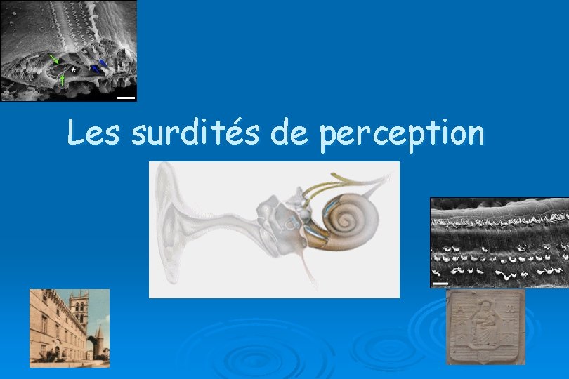 Les surdités de perception 