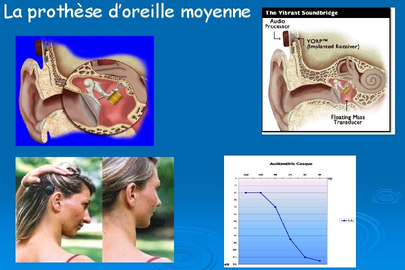 La prothèse d’oreille moyenne La prothèse d’oreille moyenne