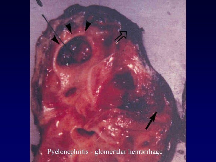 Pyelonephritis - glomerular hemorrhage 