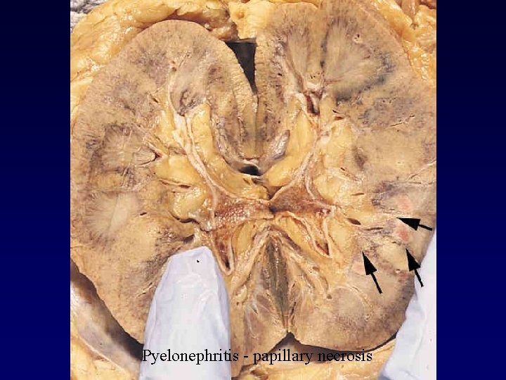 Pyelonephritis - papillary necrosis 