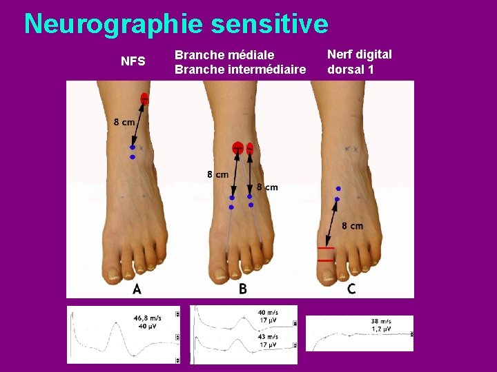 Neurographie sensitive NFS Branche médiale Branche intermédiaire Nerf digital dorsal 1 