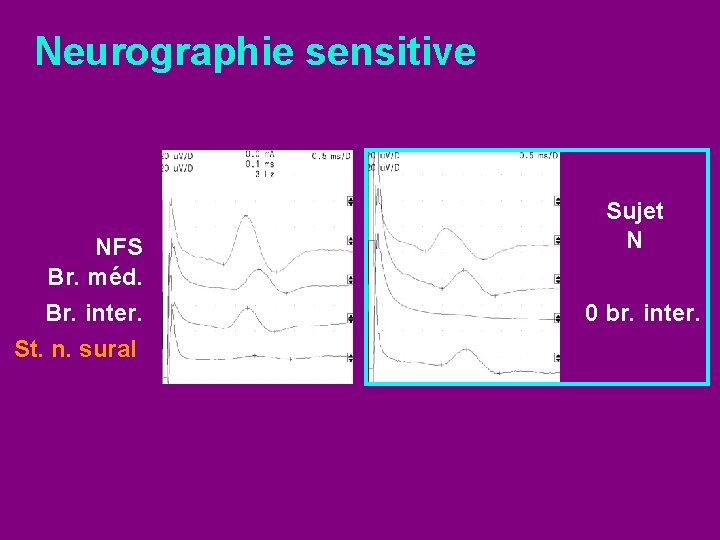 Neurographie sensitive NFS Br. méd. Br. inter. St. n. sural Sujet N 0 br.