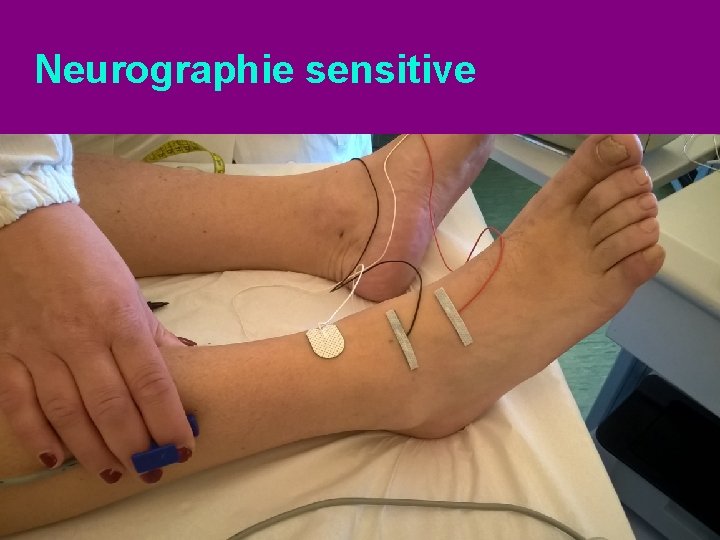 Neurographie sensitive 