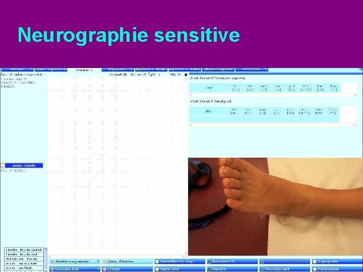 Neurographie sensitive 