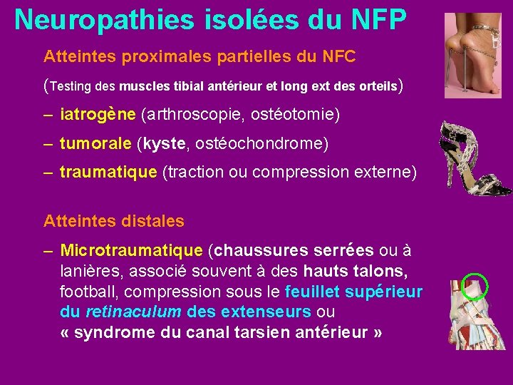 Neuropathies isolées du NFP Atteintes proximales partielles du NFC (Testing des muscles tibial antérieur