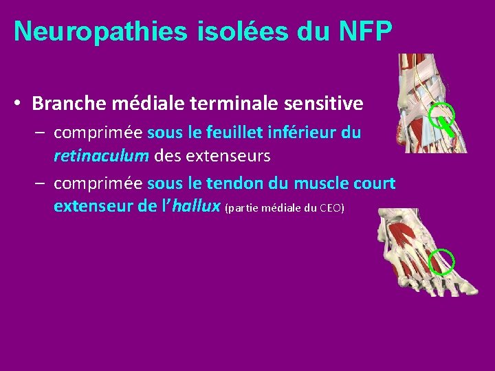 Neuropathies isolées du NFP • Branche médiale terminale sensitive – comprimée sous le feuillet