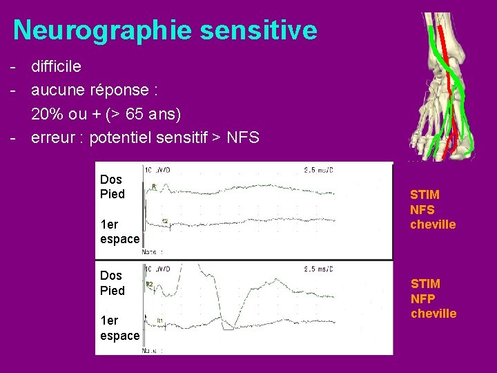 Neurographie sensitive - difficile - aucune réponse : 20% ou + (> 65 ans)