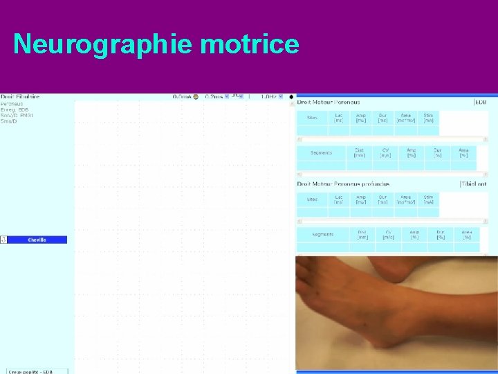 Neurographie motrice 