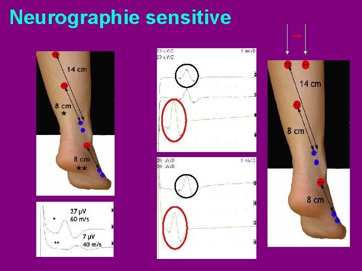 Neurographie sensitive * ** 