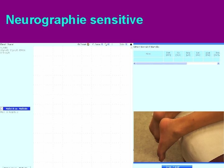 Neurographie sensitive 