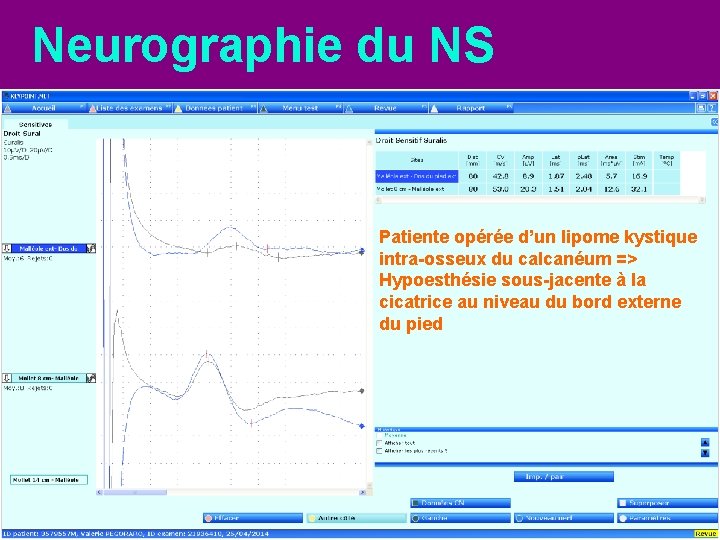 Neurographie du NS Patiente opérée d’un lipome kystique intra-osseux du calcanéum => Hypoesthésie sous-jacente