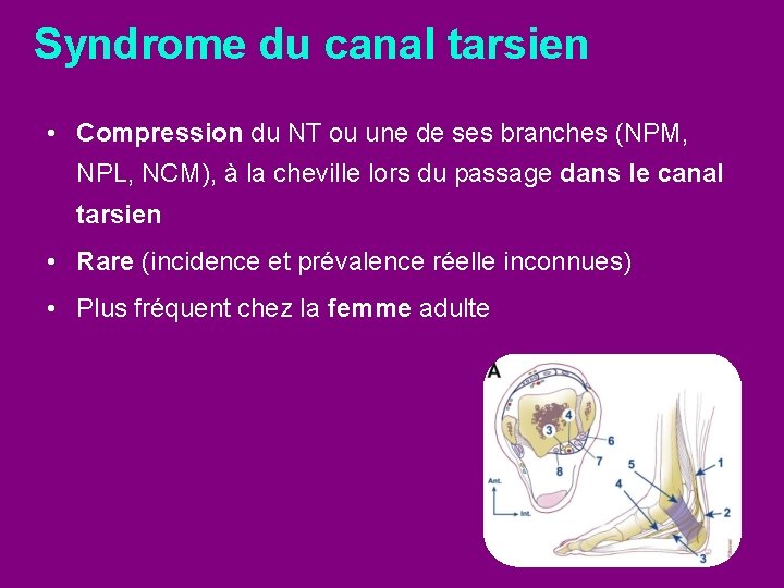 Syndrome du canal tarsien • Compression du NT ou une de ses branches (NPM,