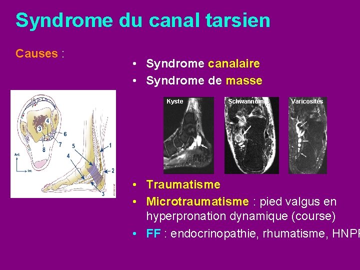 Syndrome du canal tarsien Causes : • Syndrome canalaire • Syndrome de masse Kyste