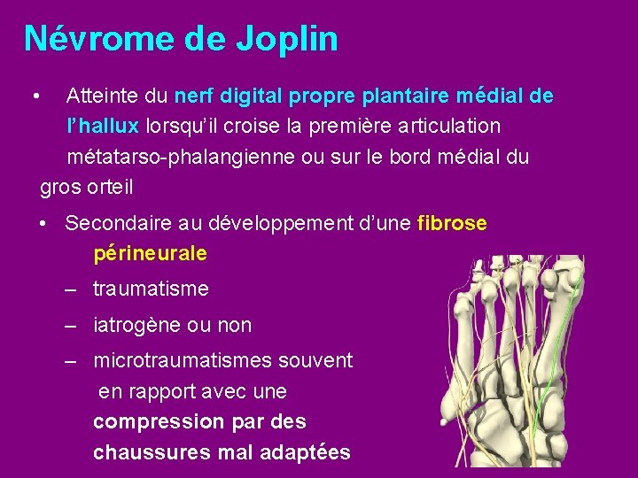 Névrome de Joplin • Atteinte du nerf digital propre plantaire médial de l’hallux lorsqu’il