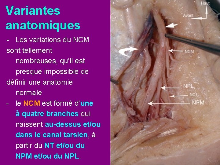 Variantes anatomiques - Les variations du NCM sont tellement nombreuses, qu’il est presque impossible