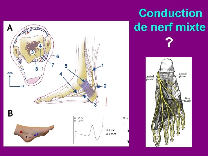 Conduction de nerf mixte ? 