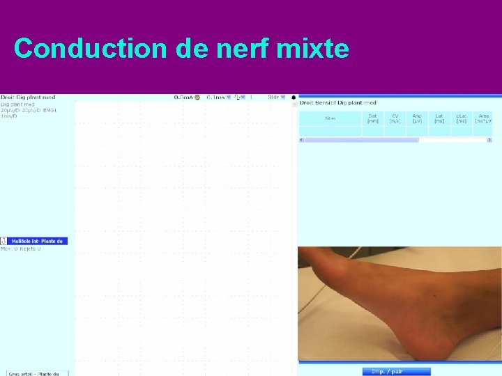 Conduction de nerf mixte 