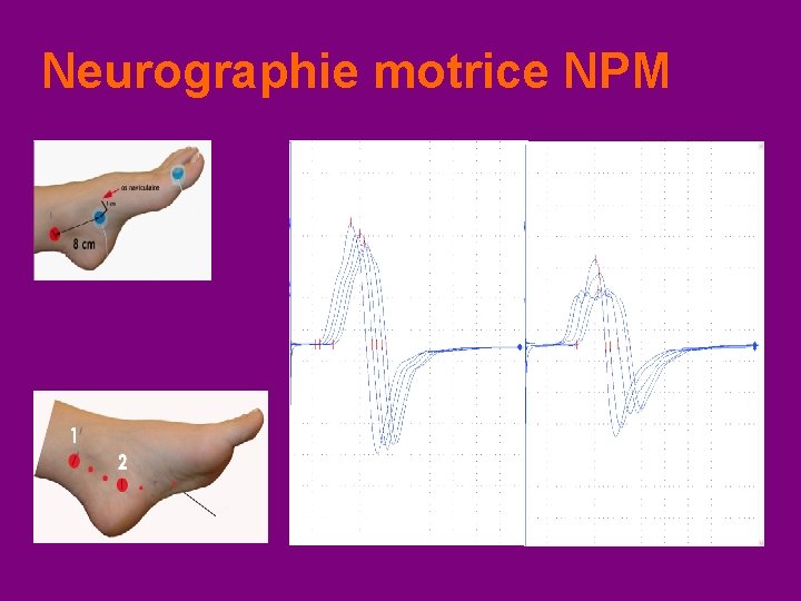 Neurographie motrice NPM 