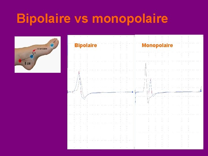 Bipolaire vs monopolaire Bipolaire Monopolaire 