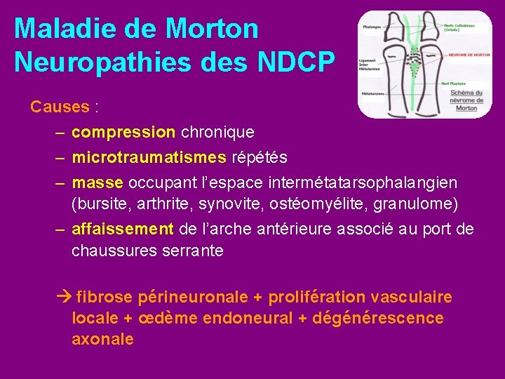 Maladie de Morton Neuropathies des NDCP Causes : – compression chronique – microtraumatismes répétés