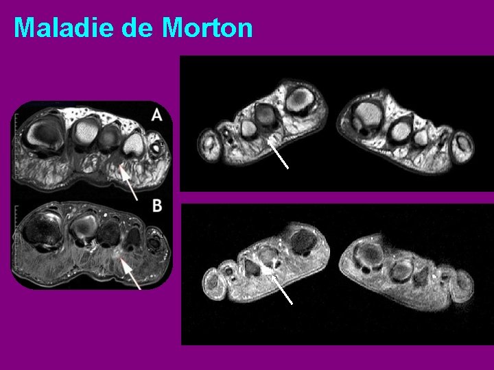 Maladie de Morton 