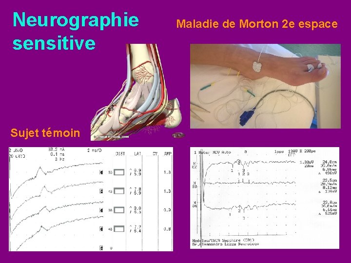 Neurographie sensitive Sujet témoin Maladie de Morton 2 e espace 
