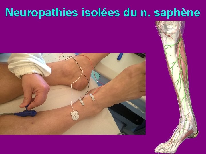 Neuropathies isolées du n. saphène 